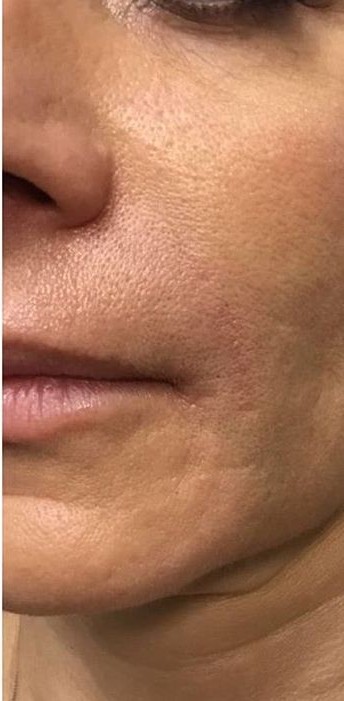 Dermal Fillers Before treatment at Dexa Clinic